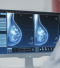 Mecanismos de acceso en Chile para el cáncer de mama
