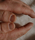 Acromegalia: síntomas y complicaciones