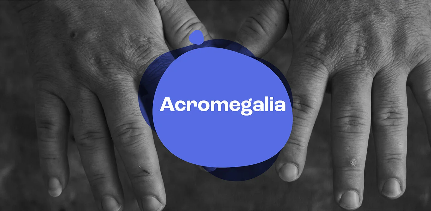 Acromegalia